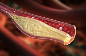 Attention, le mauvais cholestérol (LDL) est dangereux pour la santé !