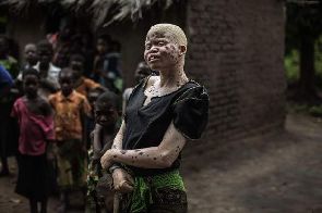 Des albinos candidats aux élections au Malawi