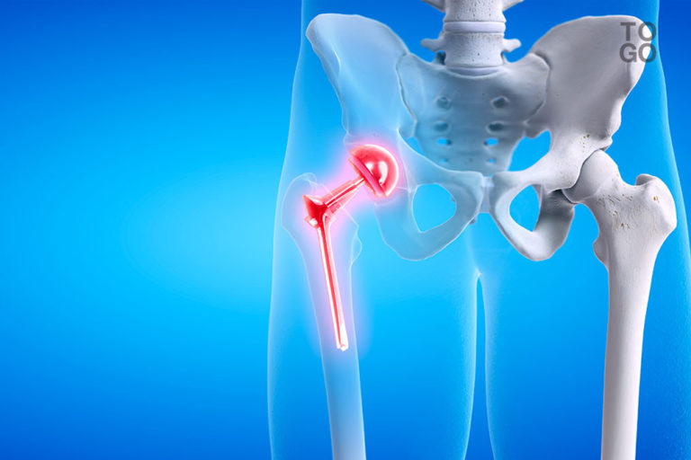Nécrose de la hanche : les chirurgiens allemands interviennent